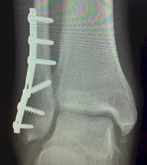 Sports Docs Weekly Blitz Ankle Fractures